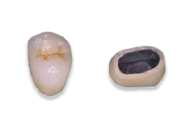 металлокерамические_коронки