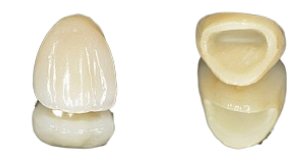 безметалловые_коронки